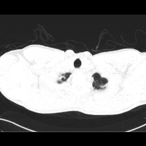 Nodular lung opacity in non-smoker 