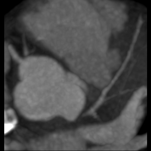 Acute coronary syndrome