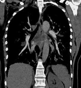 Coronal contrast-enhanced CT image at the level of the pulmonary arteries with mediastinum window setting