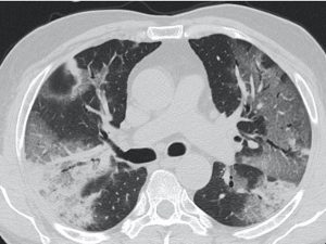 Patient with clinical signs suggestive of pneumonia