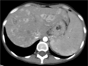 Elevated transaminase levels and abdominal pain in a 38-year-old woman