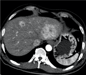 Liver metastases from neuroendocrine pancreatic tumor