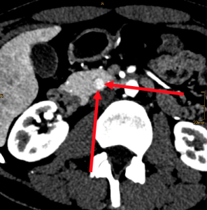 Arterial phase
