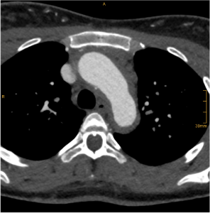 Arterial phase