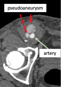 Arterial phase
