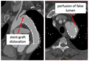 Arterial phase