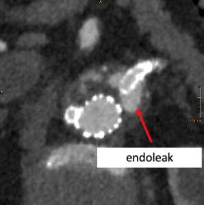 Arterial phase