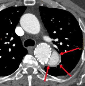Arterial phase