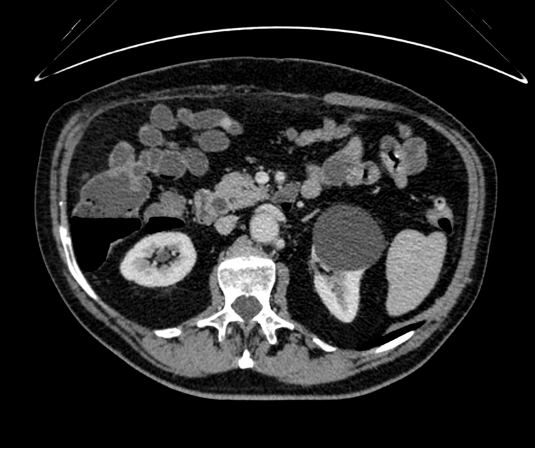 Abdominal pain in an older man with previous cholecystectomy