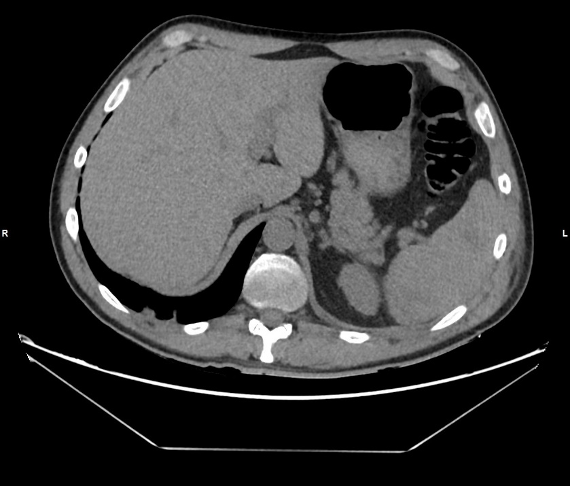 • A 46-year-old man presented at the Emergency Department with abdominal pain after a car crash • The patient exhibited hemodynamic instability and hypotension • In order to exclude any blunt abdominal trauma, contrast-enhanced abdominal CT was performed.