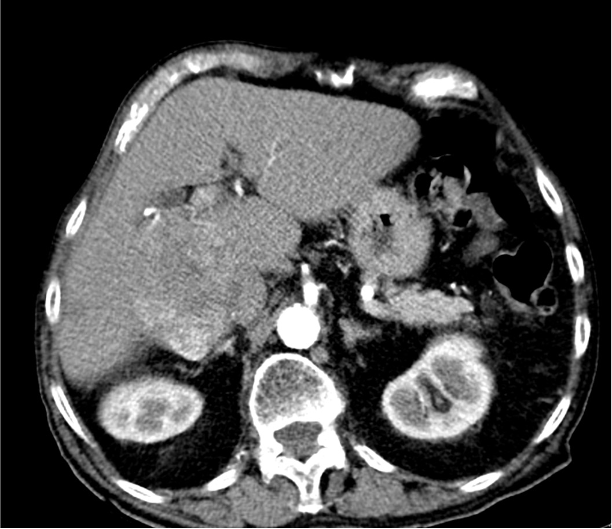 Local treatment in HCC. Man, 64 years old