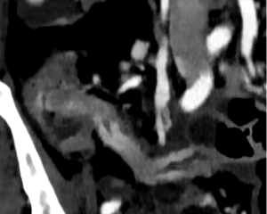 Learn how dual-layer spectral CT aids in diagnosing intestinal abnormalities and guiding clinical management.