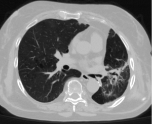 Shortness of breath, neck and facial edema, and fever in a patient with a history of lung adenocarcinoma
