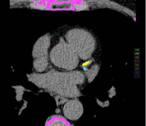 Cardiac CT reveals high-grade stenoses and high-risk plaques in a 58-year-old male. Expert CAD-RADS™ 2.0 interpretation and imaging protocol included.