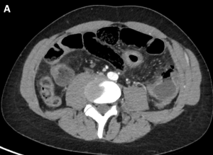 Diffuse abdominal pain and frequent diarrhea in a young man