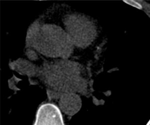 A healthy woman with intermittent chest pain on exertion