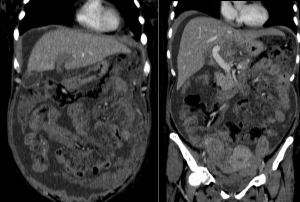 Clinical case: Patient with abdominal pain and distension with diarrhea