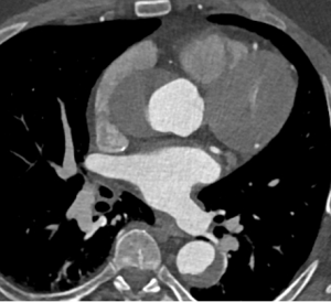 CT angiography shows an aortic arch entry tear with retrograde extension into the ascending aorta; initial surgery missed the causative lesion. MDCT.net