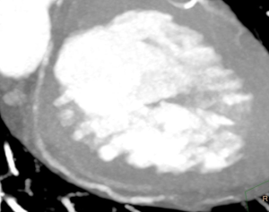 Clinical case: Acute chest pain in a healthy woman Woman, 43 years old