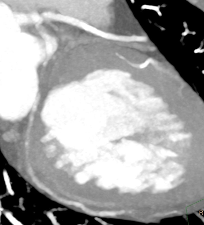 Educational cardiac CT case for radiologists and radiographers illustrating spontaneous coronary artery dissection, CAD-RADS classification, CT findings, protocols, and follow-up imaging in acute chest pain.