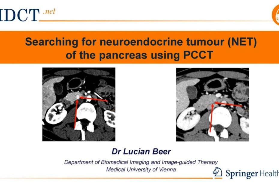 PCCT in the diagnosis of Pancreatic Neuroendocrine Tumour
