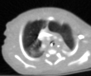 Respiratory distress in a newborn with Tetralogy of Fallot