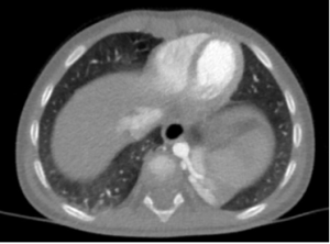 Echogenic left posterobasal lung mass observed on fetal ultrasound and MRI: postnatal characterization with contrast-enhanced chest CT