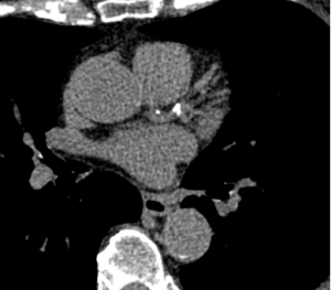 Coronary artery plaque and CAD-RADS™ 2.0 classification system Clinical Case - MDCT.net