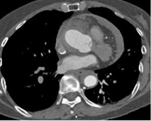CT angiography case of Stanford type B aortic dissection with retrograde intramural hematoma involving the thoracic aorta, treated with TEVAR.