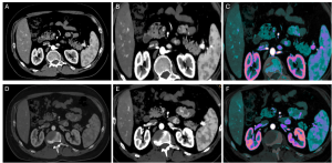 Spectral CT Case: Small Bowel Carcinoid Tumor Diagnosis - MDCT.net