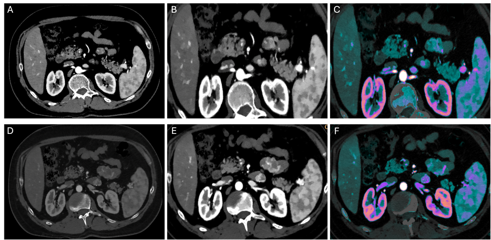 Spectral CT Case: Small Bowel Carcinoid Tumor Diagnosis - MDCT.net
