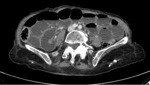 Femoral Hernia Causing Small-Bowel Obstruction: CT Case
