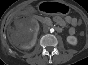 CT angiography showing acute perirenal hemorrhage caused by a renal artery pseudoaneurysm after partial nephrectomy