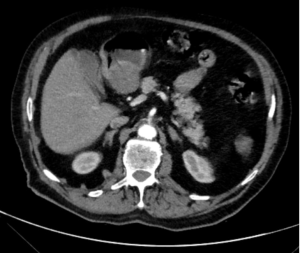 Unenhanced axial CT scan showing an exophytic gastric GIST along the lesser curvature near the pyloric region in an elderly patient with upper gastrointestinal bleeding