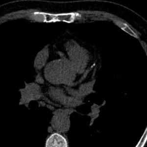 Photon-counting CT angiography showing coronary calcium scoring and RCA stenosis in a patient with multiple myeloma and suspected cardiac amyloidosis.